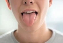 اعرف صحتك من لون لسانك